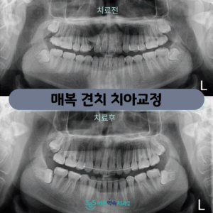 365바른약속치과-증례-썸네일-001 (2)