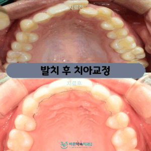 365바른약속치과 증례 썸네일-001 (1)