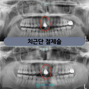 365바른약속치과-증례-썸네일-001 (3)