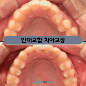 365바른약속치과-증례-썸네일-001 (4)