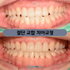 365바른약속치과-증례-썸네일-001 (5)