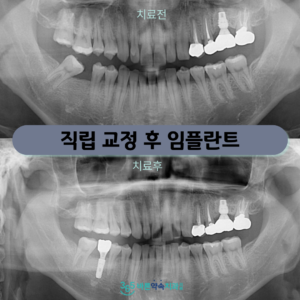 365바른약속치과-증례-썸네일-001 (6)
