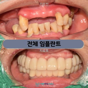 마포구청치과 전신질환으로 치과 치료를 미뤄왔다면