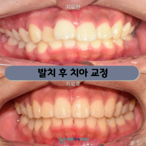 365바른약속치과-증례-썸네일-001 (9)