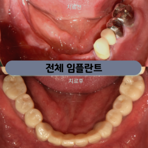 망원동치과 다수 치아를 상실하였다면