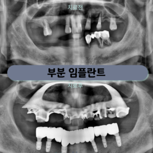망원동치과 기존 틀니가 불편하다면